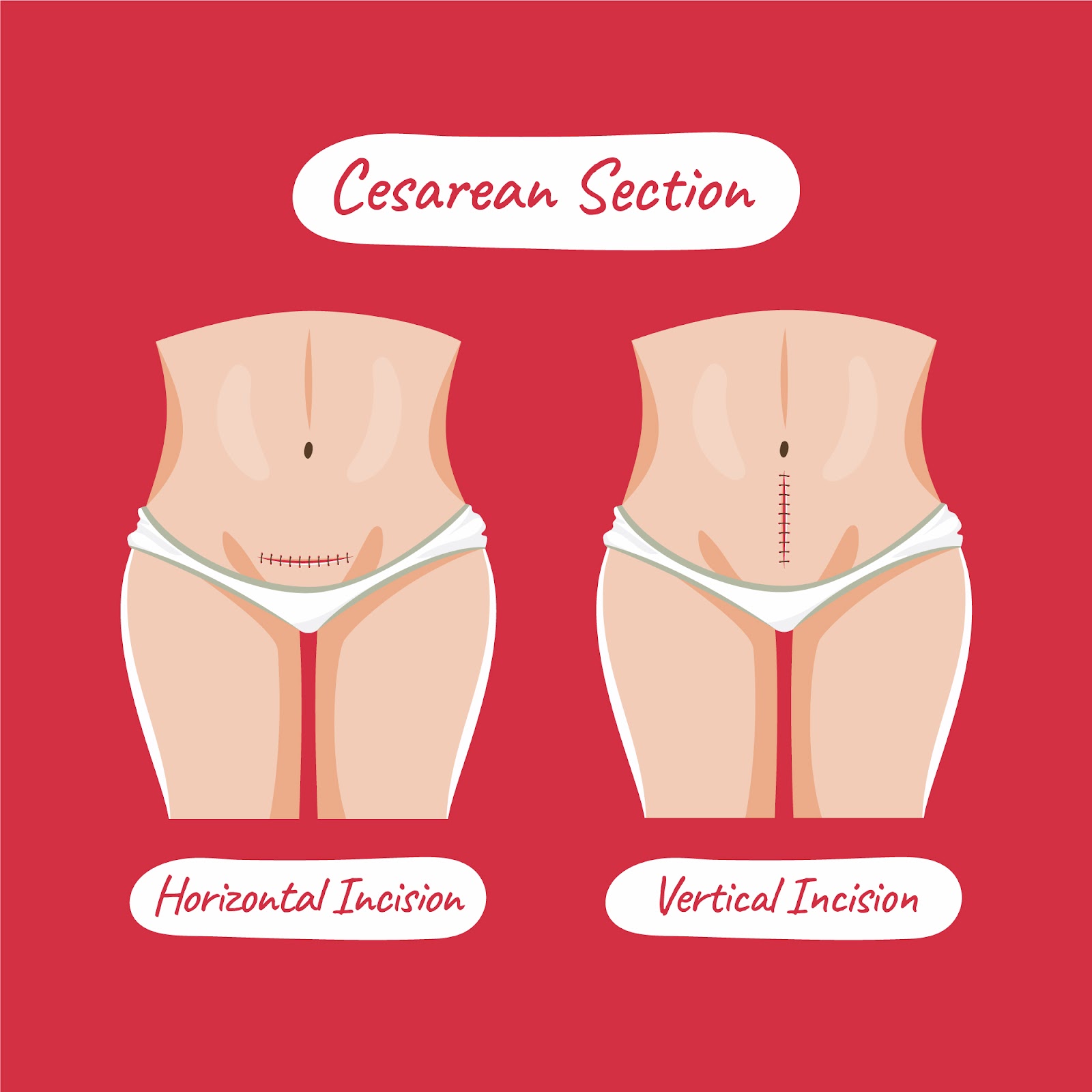teknik operasi caesar